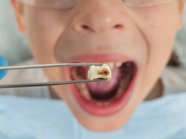 Best Emergency Treatment for Dental Infections or Abscesses in Merchantville, NJ